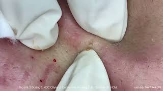 Big Cystic Acne Blackheads Extraction Blackheads amp Milia Whiteheads Removal Pimple Popping [upl. by Yahsal624]