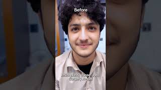 Rhinoplasty Transformation Reveal 🌟✨ Stunning Nose Job by Dr Habib 👃  Peshawar Pakistan 📍 [upl. by Nref]