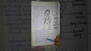 ABA xii biology Ricket amp Osteomalacia nutritional disorder causes sign amp symptomstreatment [upl. by Joline]