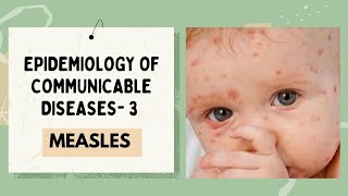 MEASLES EPIDEMIOLOGY OF COMMUNICABLE DISEASE [upl. by Pressman]