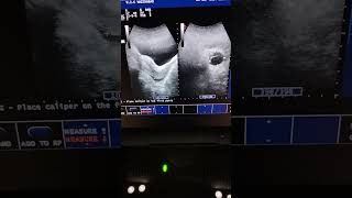 PIDultrasound pelvic ultrasound inhomeultrasoundseptated cyst in left adnexa [upl. by Iolanthe]