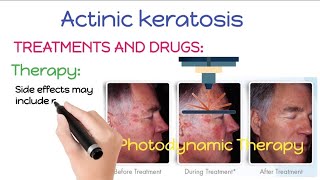 How To Treat and Remove Actinic Keratosis  Actinic Keratosis Treatment And Removal Procedures [upl. by Cort370]