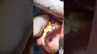 خطوة بخطوة تركيب دعامات الأسنان وطربوش الأسنان post and core dental restoration [upl. by Enelia898]