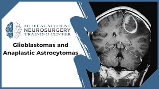 Glioblastomas and Anaplastic Astrocytomas [upl. by Aicinat]