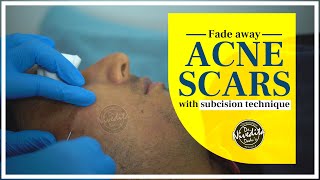 Subcision Treatment for Acne Scars  Acne Scars Treatment [upl. by Attikin]