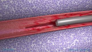 Peripheral IV Phlebitis Animation [upl. by Haimes756]