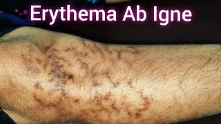 Erythema Ab Igne in Women [upl. by Veal]