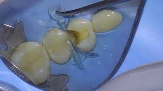 CLASS 2 COMPOSITE RESTORATIONS PERFROMED WITH RUBBER DAM [upl. by Kablesh]