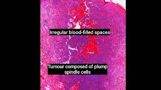 Histopathology of Aneurysmal Dermatofibroma dermpath dermatopathology pathology shorts [upl. by Ecirb39]