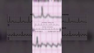 Atrial fibrillation vs Atrial flutter  Medicos  Cardiology [upl. by Wartow]