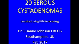 serous cystadenomas YouTube Feb 2017 [upl. by Anaerdna]