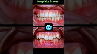 Braces process deep bite braces orthodontist dentist deepbite [upl. by Audie39]