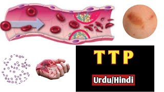 Thrombotic thrombocytopenic purpuraHemolytic uremic syndrome In urduHindiDoctors goalanimation [upl. by Yticilef]