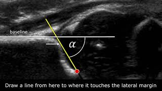 Congenital Hipdysplasia  How to measure angles [upl. by Ennaitak286]