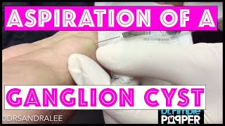 Aspiration of a ganglion cyst [upl. by Adrahc]