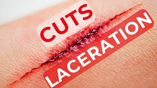 Emergency Tips for Cuts or Lacerations – Stop Bleeding Fast [upl. by Ahsita581]