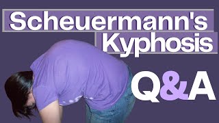 Common Questions About Scheuermanns Kyphosis [upl. by Wendie]