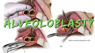 Alveoloplasty [upl. by Simone]