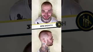 Hair Transplant Before amp After  12 Months Results [upl. by Derrek]