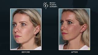 Lift and Define Your Face Without Incisions With the Xact™ Device [upl. by Laval237]