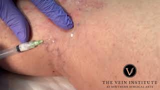 More Sclerotherapy Treatment for Spider Veins [upl. by Tierney]