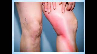 What is Phlebitis and How is it Treated [upl. by Yim]