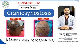 Before After Ep 12  Craniosynostosis Surgery  By Best Paediatric Neurosurgeon Nafaur in Bangladesh [upl. by Ylrac]