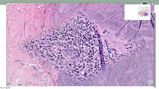 Surgical Pathology Update Diagnostic Pearls for the Practicing Pathologist  CME Teaching Activity [upl. by Vyner]