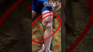 Dislocation of the knee joint shorts [upl. by Assilym]