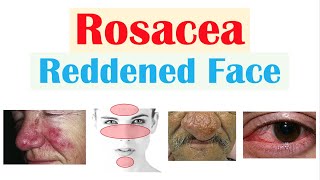 Rosacea Red Lesions on Face  Causes Triggers Types Signs amp Symptoms Diagnosis Treatment [upl. by Kram264]