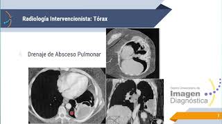 Radiología Intervencionista [upl. by Falconer800]