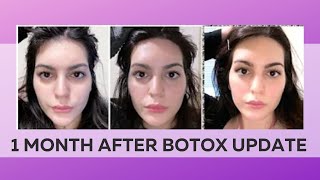 The Incredible Results of Botox  Before amp After [upl. by Marcella616]