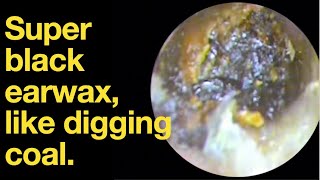 Super black earwax like digging coal ear wax removal  ear cleaning  ASMR  relaxation  relax [upl. by Arhaz171]