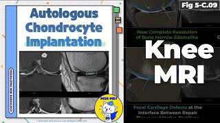 Fig 5C09 MRI Findings of Autologous Chondrocyte Implantation [upl. by Ecertal]