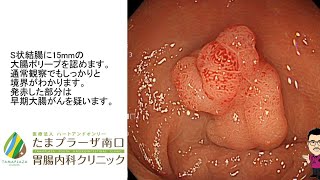 たまプラーザ南口胃腸内科クリニック～早期大腸がん 日帰り内視鏡治療 EMR～ [upl. by Ellennoj]