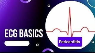 ECG Basics  ECG Changes in Pericarditis  Benign Early Repolarization Vs Pericarditis [upl. by Auvil]