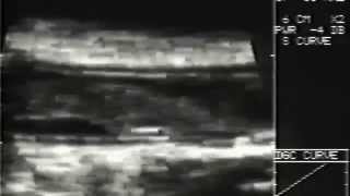 Ultrasound Appearance of Acute Thrombosis The First Human Experiment 1983 [upl. by Nosnarb]