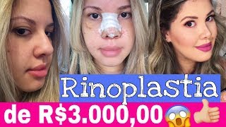 Rinoplastia de R300000 [upl. by Damas644]