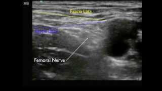 Femoral Nerve anatomy [upl. by Burrton157]