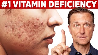 The Top Vitamin Deficiency with Acne [upl. by Oetam]