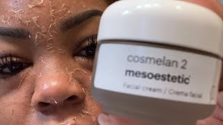 My unbelievable 30 day Cosmelan Peel journey [upl. by Tnomed]