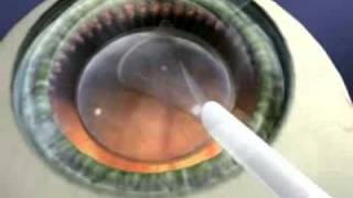 Staar Surgical Visian ICL Implantation [upl. by Bergwall284]