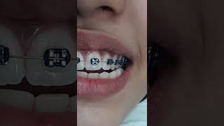 Ortho treatment BracesBy Dr Ayesha Orthodontist [upl. by Grani192]