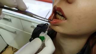 Anesthesia  Labret  Dudak Piercing Delimi [upl. by Mingche]