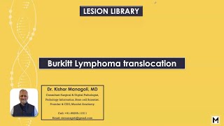 Pathology of Burkitt Lymphoma Translocation [upl. by Sturges916]