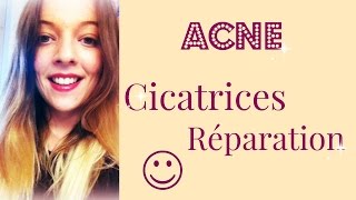 ACNE  Faire disparaître les cicatrices trucs et astuces [upl. by Aimekahs909]