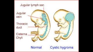 Applied anatomy of posterior triangle of the neck  Troisers sign  Cystic hygroma  Cystic lymphan [upl. by Lemak]