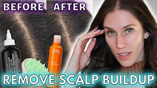 🧀 How I Got Rid Of Scalp Buildup  How To Remove Scalp Buildup amp Scalp Exfoliation Favorites [upl. by Mcquade]