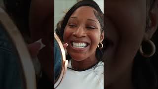 From black teeth to white teeth veneers porcelainveneers dentalveneers [upl. by Olivero]