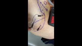 Electrical Dry Needling to Trigger Points in the Gluteus Medius and Minimus Muscles [upl. by Squire]